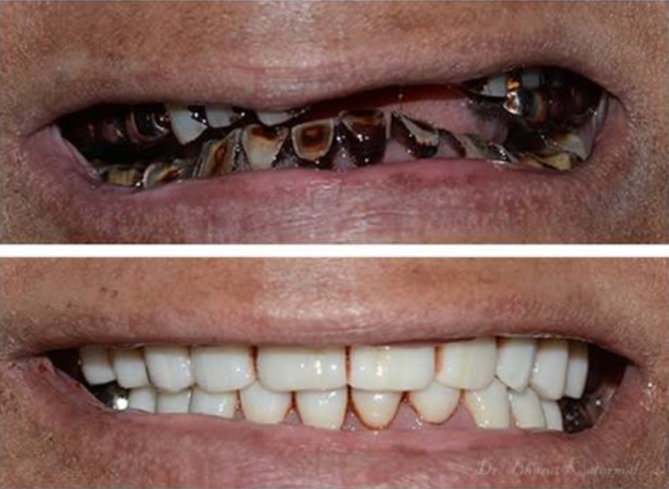 Full Mouth Rehabilitation Vadodara